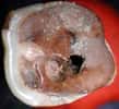 Une molaire du néolithique travaillée par un dentiste préhistorique(Crédits : Roberto Macchiarelli, Université de Poitiers)