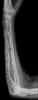 Le myélome multiple peut s'observer sur une radiographie du squelette : des taches plus sombres indiquent la dégradation de l'os par les tumeurs ostéolytiques. Ici, il s'agit de l'avant-bras d'un patient. © Hellerhoff / Licence Creative Commons