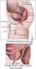 Schéma indiquant la place de la prostate dans l'appareil génital masculin. Son rôle consiste à sécréter le liquide séminal, composant indispensable du sperme. © National Cancer Institute, Wikipédia, DP
