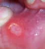 Les aphtes apparaissent le plus souvent sur les gencives, à l’intérieur des joues, sur les lèvres ou sur la langue. Quelquefois néanmoins, ils touchent les organes génitaux. © TheBlunderbuss, Wikipédia, cc by sa 3.0