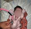 Le bébé né en Inde avec des membres supplémentaires. © Newslions,&nbsp;SWNS