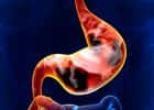 Le cancer de l’estomac touche plus d’hommes que de femmes. © decade3d, Fotolia