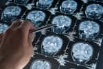 L'accumulation d'une protéine, l'alpha-synucléine, dans le cerveau est bien liée à certaines formes de la maladie de Parkinson, confirme une étude. © haydenbird, Getty Images