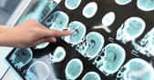 La maladie d’Alzheimer est liée à la présence de dépôts amyloïdes dans le cerveau. L’anticorps testé permet de les éliminer. © sfam_photo, Shutterstock
