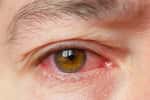 L'œil peut être le théâtre d'infections inhabituelles. © andrei310, Adobe Stock
