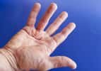 La maladie de Dupuytren entraîne une déformation de la main avec des doigts figés en crochet. © perfectmatch, Adobe Stock