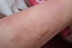 L’érysipèle est une infection de la peau due à une bactérie. © retbool, Adobe Stock