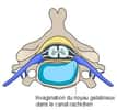 Schéma d'une hernie discale. Comme dans toute hernie, un organe fait saillie dans un autre. Ici, c'est le noyau gélatineux contenu dans le disque intervertébral qui s'invagine dans le canal rachidien (qui contient la moelle épinière). Cette intrusion peut provoquer une douleur locale (lombalgie par exemple) ou diffuse quand elle vient comprimer la racine d'un nerf (sciatique par exemple). © Debivort, cc