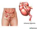 L'appendice iléo-cæcal est une excroissance du cæcum, qui peut s'enflammer. © www.health.allrefer.com