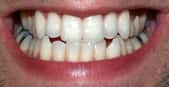Les dents sont aussi protégées des caries par la salive. © David Shankbone, Wikimedia, CC by-sa 3.0