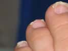 Les ongles des orteils sont soumis à rude épreuve dans les chaussures, provoquant l'apparition d'ongles incarnés. © Filip Malkovic, Wikimedia, CC by-sa 2.0