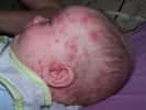 La varicelle touche le plus souvent les enfants, provoquant l'apparition de vésicules sur l'ensemble du corps. © ILJR, Wikimedia, CC by-sa 3.0