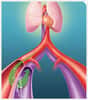 Un implant de la taille d’un trombone crée une connexion entre l'artère et la veine de la cuisse pour réduire la pression artérielle. ©Rox Medical