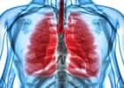 Un essai clinique de phase 3 rapporte de bons résultats dans la survie globale des patients atteints par le plus courant des cancers du poumon. © Yodiyim, Fotolia