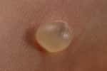 Cette petite bulle, la cloque, peut se former pour mille et une raisons. Elle contient souvent du plasma sanguin mais peut aussi se remplir de pus, un liquide composé de cellules de l'immunité et de tissus morts. © Frazzmatazz, Wikipédia, cc by sa 3.0