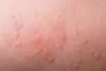 Eczéma chez le bébé : pas de bains trops chauds - Source : Rob Byron - Fotolia.com