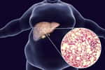 Stéatose du foie chez un homme obèse&nbsp;© Kateryna_Kan, Adobe Stock