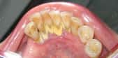 Le détartrage consiste à retirer le tartre qui s’est accumulé sur les dents, comme à la base des dents de cette mâchoire. © DRosenbach, Wikipédia, DP