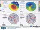 La topographie cornéenne permet d’analyser la courbure de la cornée. © Digital Journal of Ophtalmology