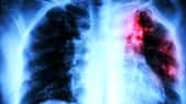 La tuberculose reste une maladie très présente en France