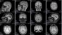 IRM d'un cerveau. © Delphotostock, Adobe Stock 