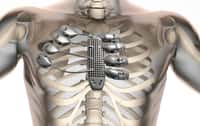 Un sternum et des côtes ont été imprimés en 3D en Australie et implantés dans un patient espagnol. © Anatomics 