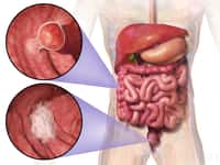 Le cancer colorectal peut se développer dans le côlon ou le rectum, qui font tous deux partis du gros intestin. © Blausen Medical Communications, Inc., Wikimedia Commons, cc by 3.0