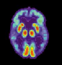 Cerveau d’un patient souffrant d’Alzheimer observé par TEP (tomographie par émission de positons) © US National Institute on Aging, Alzheimer's Disease Education and Referral Center, administration américaine, DP