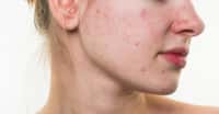 L’acné est souvent difficile à vivre pour les ados et les jeunes adultes. Mais elle pourrait être le signe d’une peau qui vieillira moins vite. © Loginova Elena, Shutterstock
