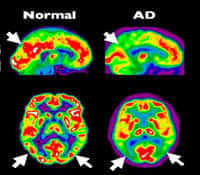 Tomographie par émission de positons (PET Scan en anglais) d’un cerveau en bonne&nbsp;santé en comparaison avec un cerveau atteint d’Alzheimer à un stade précoce. © Institut Douglas, Flickr, cc&nbsp;by nc sa 2.0