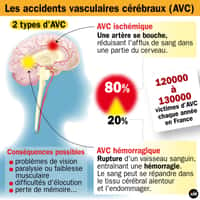 Il existe deux types d'accident vasculaire cérébral&nbsp;: l'AVC ischémique et l'AVC hémorragique. On en compte 1 toutes les 4 minutes en France.&nbsp;©&nbsp;idé