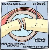 Dans la polyarthrite, les éléments de l'articulation sont touchés : l'os, le cartilage, la membrane synoviale, les ligaments et même les tendons. © Andar (voir le lien ci-dessous)