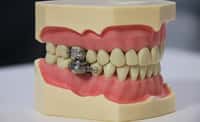 Le dispositif DentalSlim Diet Control empêche la bouche de s’ouvrir de plus de deux millimètres. © Université d'Otago