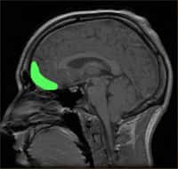 En vert, le cortex orbitofrontal, en jeu lorsqu'il s'agit de maîtriser nos impulsions. Crédit : Paul Wicks