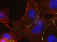 Ces cellules de lignée Hep3B sont issues d'un patient avec un cancer du foie, et déficientes en un gène :&nbsp;Hnf1a. En rouge on peut voir apparaître la N-cadhérine, en vert la phalloïdine et les noyaux sont bleus.&nbsp;© Jessica Zucman-Rossi,&nbsp;Inserm