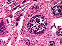 Cellule cancéreuse agrandie 2100 x. Crédit : www.microscopies.com