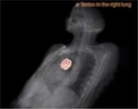 Une zone particulière, par exemple une lésion (ici dans un poumon), peut être mise en évidence par le praticien examinant les images obtenues avec un scanner 3D et visualisées par le logiciel InnerEye. © Microsoft Research