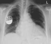 Aujourd'hui, certains patients avec de graves troubles cardiaques se voient opérés et équipés d'un pacemaker, comme on le voit à l'image. Même si l'outil prolonge la vie, il n'est pas sans contrainte, car il faut changer les piles tous les 5 à 7 ans en moyenne, ce qui implique de la chirurgie lourde et régulière. Cette nouvelle technique de pacemaker biologique, si elle montre son efficacité et sa durabilité, pourrait nécessiter un seul et unique traitement. © Lucien Monfils, Wikipédia, cc by sa 3.0