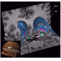 Les deux régions d'implantation des électrodes de la stimulation cérébrale profonde repérées par l'équipe de Luc Mallet. La zone correspondant aux troubles obsessionnels convulsifs (TOC) est située dans le noyau sous-thalamique (donc situé sous le thalamus). Juste à côté se trouve une région impliquée dans la maladie de Gilles de Tourette (MGT). © Inserm/CNRS/Inra