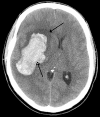Ce scanner montre un écoulement sanguin dans le cerveau (en blanc) consécutif à un accident vasculaire cérébral important, tandis que la tâche sombre juste au-dessus correspond à l'œdème qui en découle. © James Heilman, Wikipédia, cc by sa 3.0
