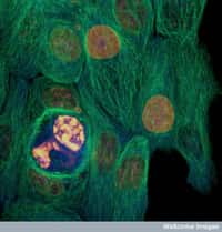 Le cancer du sein, dont on voit des cellules tumorales à l'image, est le plus fréquent et le plus meurtrier chez la femme. En France, 53.000 nouveaux cas ont été détectés (33 % de l'ensemble des cancers) en 2011, et 11.500 personnes en sont mortes (18 % de la mortalité).&nbsp;© David Becker, Wellcome Images, Flickr, cc by nc nd 2.0