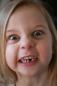 Le bisphénol A et d'autres perturbateurs endocriniens pourraient être à l'origine d'une maladie des dents récemment décrite chez les enfants, appelée MIH. Celle-ci se caractérise par des taches blanches causées par une hypominéralisation, rendant les dents plus sensibles à la douleur et plus susceptibles aux caries. © Foamcow, Flickr, cc by nc nd 2.0