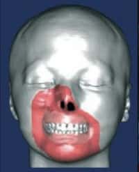 Schéma de la première greffe partielle de visage. © DR