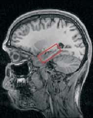 L'hippocampe est une structure du cerveau (encadrée en rouge) impliquée dans la mémorisation des souvenirs. © Eleanor Maguire