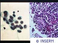 Histologie du cancer du poumon à l'aide d'une coloration standard utilisée en anatomo-pathologie. La partie droite de la diapositive montre un tissu cancéreux avec de gros noyaux cellulaires, en noir.
Crédits : INSERM