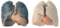 A gauche des poumons d'un fumeur (la couleur noire proviens des goudrons). A droite des poumons sains.