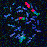 Caryotype humain (provenant d'une amniocentèse) montrant une fusion entre un chromosome (coloré en rouge) et un chromosome différent (coloré en vert). Cette fusion est souvent la conséquence d'une cassure double brin de l'ADN.