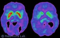 L'IRM de diffusion : surveiller les tumeurs du cerveau
