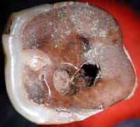 Une molaire du néolithique travaillée par un dentiste préhistorique(Crédits : Roberto Macchiarelli, Université de Poitiers)