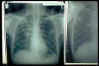 Poumons de patient atteint de tuberculose.